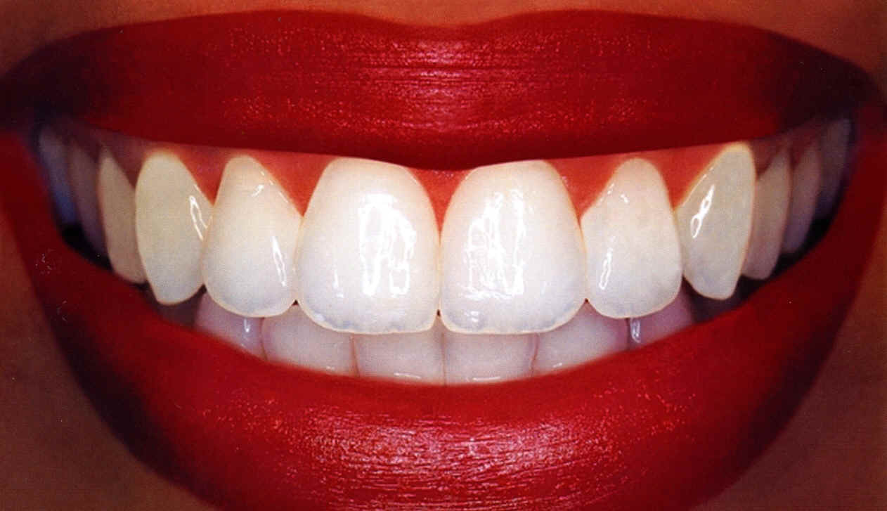 Resultado de un tratamiento de estética dental